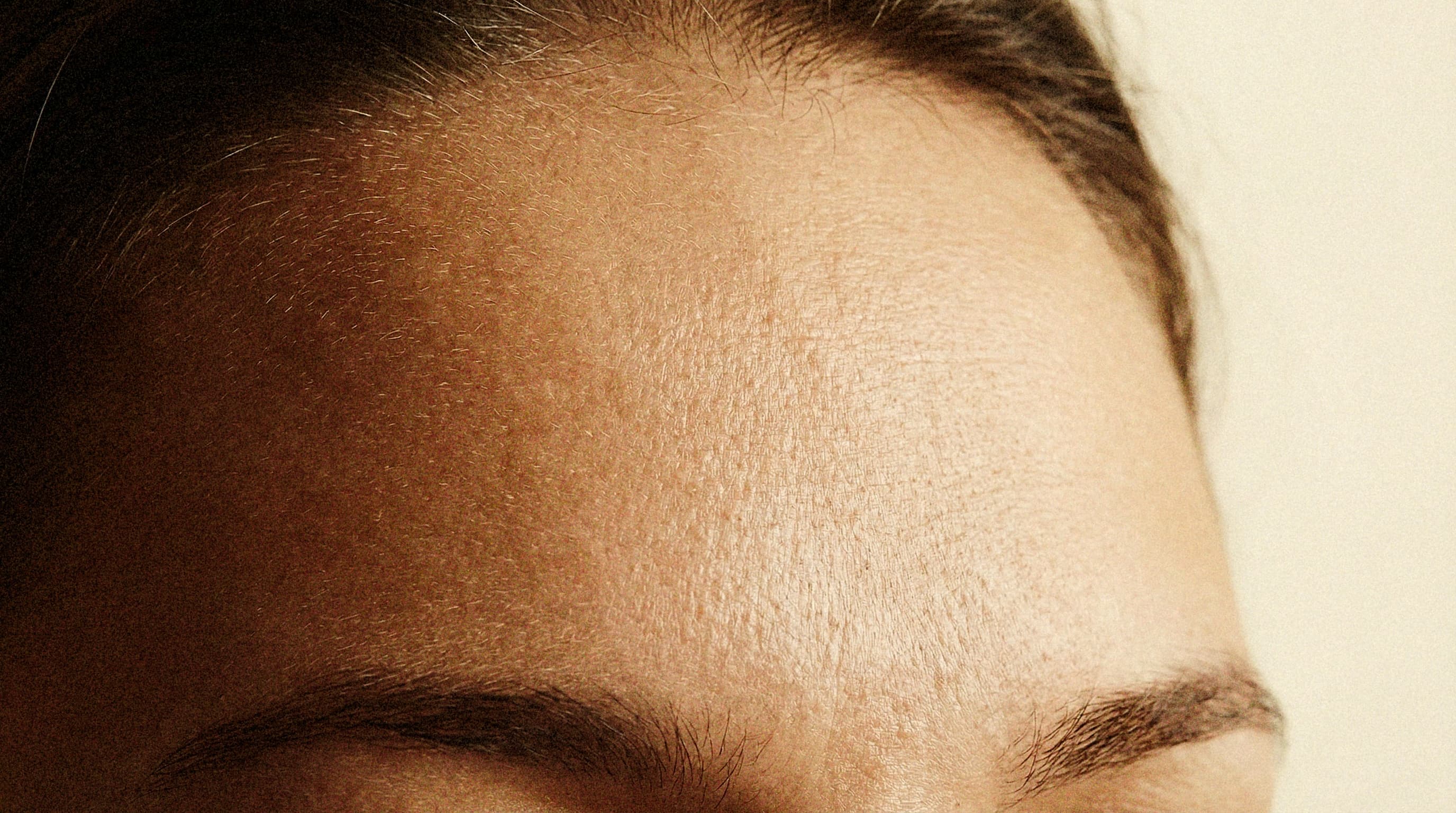 Forehead/Temple Lift Surgery