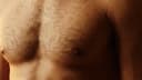 Gynecomastia